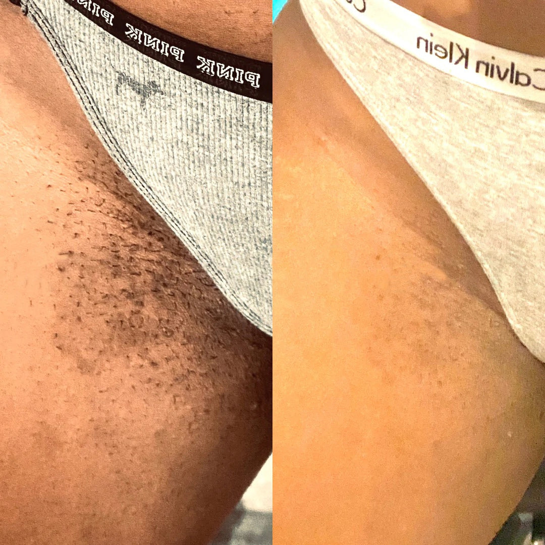 Brightening Cream for Hyperpigmentation
