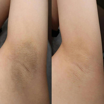 Brightening Cream for Hyperpigmentation