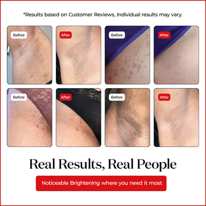 Brightening Cream for Hyperpigmentation