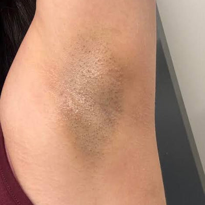Fade Dark Spots Fast